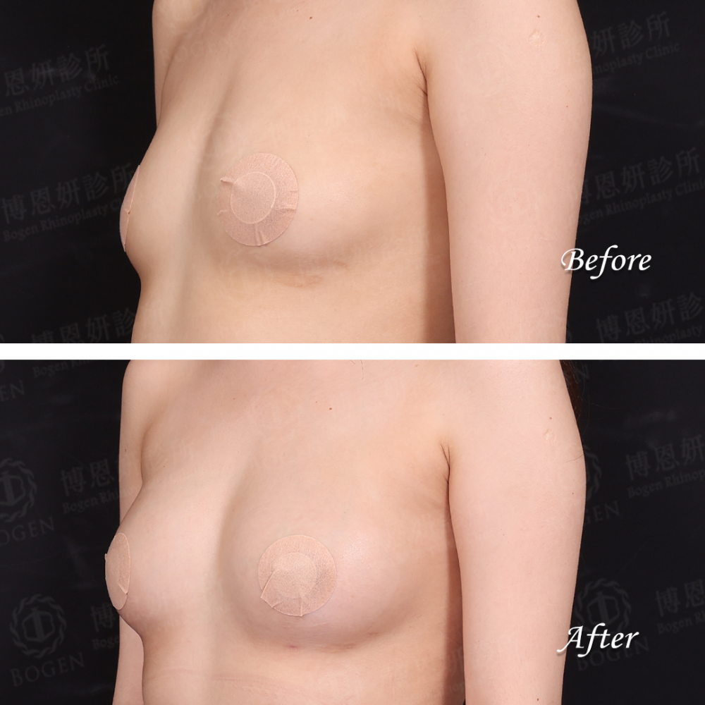 自體脂肪移植,自體脂肪移植胸部,自體脂肪移植隆乳,博恩妍